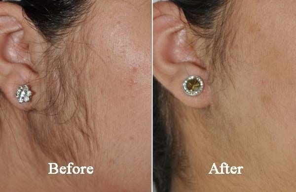 Hair Permanent Removal